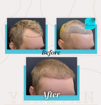 Slider image (5) United Hair Clinic